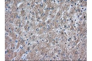 Immunohistochemical staining of paraffin-embedded Carcinoma of Human prostate tissue using anti-ACAT2 mouse monoclonal antibody.
