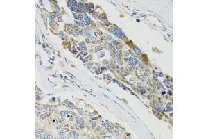 Immunohistochemistry of paraffin-embedded human liver cancer using SH2B1 Antibody (ABIN5973245) at dilution of 1/100 (40x lens). (SH2B1 antibody)