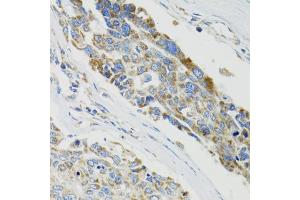 Immunohistochemistry of paraffin-embedded human liver cancer using SH2B1 Antibody (ABIN5973245) at dilution of 1/100 (40x lens).