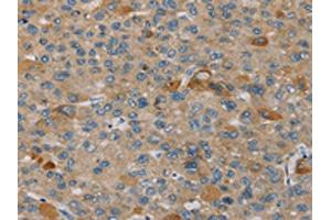 The image on the left is immunohistochemistry of paraffin-embedded Human liver cancer tissue using ABIN7130584(PEF1 Antibody) at dilution 1/20, on the right is treated with fusion protein. (PEF1 antibody)