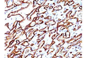 Immunohistochemical staining of human angiosarcoma (20X) with PODXL monoclonal antibody, clone 3D3  at 1:500 dilution.