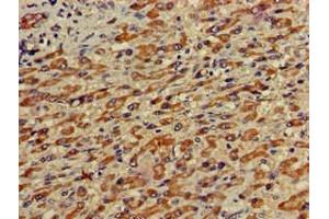 Immunohistochemistry of paraffin-embedded human liver cancer using ABIN7155043 at dilution of 1:100 (c-MET antibody  (AA 83-209))