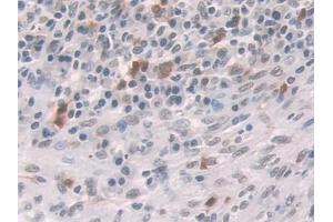 IHC-P analysis of Human Colorectal cancer Tissue, with DAB staining.