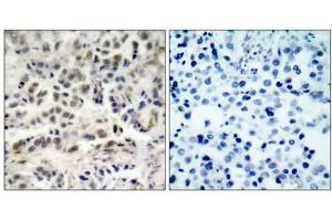 Immunohistochemical analysis of paraffin-embedded human lung carcinoma tissue using p27Kip1 (Ab-10) antibody (E021150). (CDKN1B antibody)