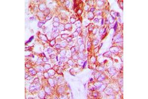 Immunohistochemical analysis of HER3 (pY1328) staining in human breast cancer formalin fixed paraffin embedded tissue section. (ERBB3 antibody  (C-Term, pTyr1328))