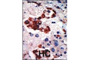 Formalin-fixed and paraffin-embedded human cancer tissue reacted with the primary antibody, which was peroxidase-conjugated to the secondary antibody, followed by AEC staining. (PKC iota antibody  (N-Term))