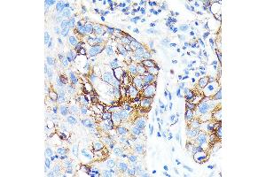 Immunohistochemistry of paraffin-embedded Human lung cancer using ICAM-1/CD54 antibody (ABIN7267941) at dilution of 1:100 (40x lens). (ICAM1 antibody)