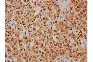 IHC image of ABIN7155258 diluted at 1:400 and staining in paraffin-embedded human liver cancer performed on a Leica BondTM system. (HRG antibody  (AA 412-511))