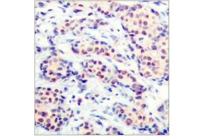 Immunohistochemical analysis of paraffin-embedded human breast carcinoma tissue using JunD(Ab-255) Antibody (JunD antibody)