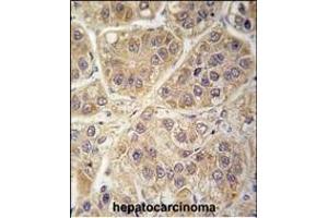 Formalin-fixed and paraffin-embedded human hepatocarcinoma tissue reacted with SARS2 antibody (Center) (ABIN392301 and ABIN2841955) , which was peroxidase-conjugated to the secondary antibody, followed by DAB staining. (SARS2 antibody  (AA 315-344))