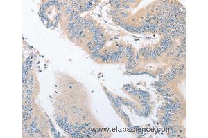 Immunohistochemistry of Human colon cancer using EPS15L1 Polyclonal Antibody at dilution of 1:30 (EPS15L1 antibody)