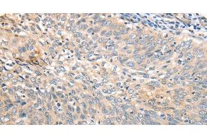 Immunohistochemistry of paraffin-embedded Human cervical cancer tissue using APTX Polyclonal Antibody at dilution 1:50 (Aprataxin antibody)