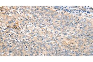 Immunohistochemistry of paraffin-embedded Human cervical cancer tissue using APTX Polyclonal Antibody at dilution 1:50 (Aprataxin antibody)