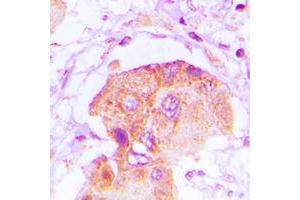 Immunohistochemical analysis of EPS8L2 staining in human lung cancer formalin fixed paraffin embedded tissue section. (EPS8-Like 2 antibody  (N-Term))