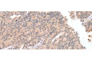 Immunohistochemistry of paraffin-embedded Human prost at e cancer tissue using DEFB112 Polyclonal Antibody at dilution of 1:40(x200) (DEFB112 antibody)