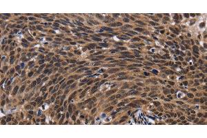Immunohistochemistry of paraffin-embedded Human cervical cancer tissue using FASTKD5 Polyclonal Antibody at dilution 1:40 (FASTKD5 antibody)