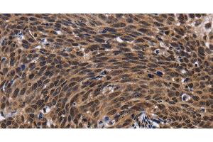 Immunohistochemistry of paraffin-embedded Human cervical cancer tissue using FASTKD5 Polyclonal Antibody at dilution 1:40