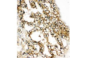 Anti-COMT antibody, IHC(P) IHC(P): Human Kidney Cancer Tissue (COMT antibody  (N-Term))