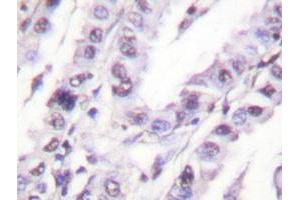 Immunohistochemical analysis of paraffin-embedded human lung carcinoma tissue using XRCC5 polyclonal antibody . (XRCC5 antibody)