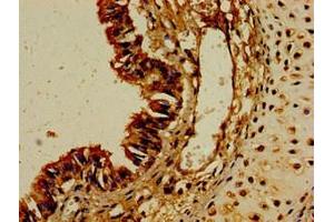 Immunohistochemistry of paraffin-embedded human colon cancer using ABIN7149202 at dilution of 1:100 (CYP1A1 antibody  (AA 97-254))