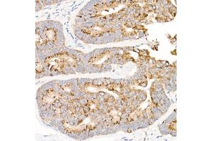 Immunohistochemistry of paraffin-embedded human colon carcinoma using MT-ND2 Rabbit pAb (ABIN7268600) at dilution of 1:50 (40x lens). (MT-ND2 antibody  (C-Term))
