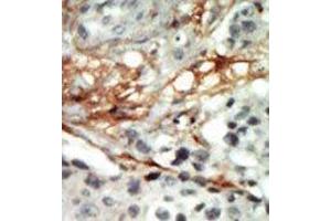 Formalin-fixed and paraffin-embedded human cancer tissue reacted with the primary antibody, which was peroxidase-conjugated to the secondary antibody, followed by AEC staining. (PRKAB2 antibody  (N-Term))