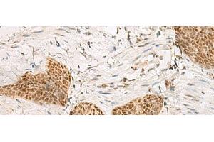 Immunohistochemistry of paraffin-embedded Human esophagus cancer tissue using PSPC1 Polyclonal Antibody at dilution of 1:30(x200) (PSPC1 antibody)
