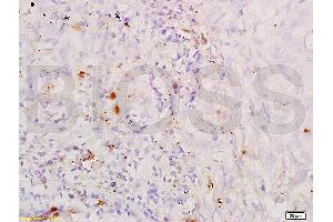 Formalin-fixed and paraffin embedded human lung carcinoma labeled with Anti-SP-D PSPD Polyclonal Antibody, unconjugated (ABIN731678) at 1:200, followed by incubation with conjugated secondary antibody and DAB staining. (SFTPD antibody  (AA 301-375))