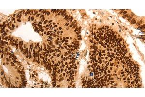 Immunohistochemistry of paraffin-embedded Human colon cancer tissue using E2F7 Polyclonal Antibody at dilution 1:60 (E2F7 antibody)