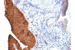 Formalin-fixed, paraffin-embedded human Bladder Carcinoma stained with Cytokeratin 19 Monoclonal Antibody (SPM561)