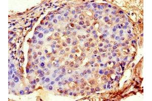 Immunohistochemistry of paraffin-embedded human breast cancer using ABIN7143140 at dilution of 1:100 (Actin, gamma 1 antibody  (AA 13-166))