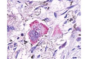 Anti-GPR48 / LGR4 antibody IHC of human Lung, Adenocarcinoma. (LGR4 antibody  (C-Term))
