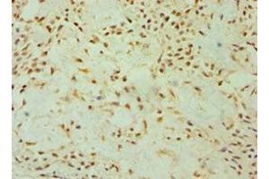 Immunohistochemistry of paraffin-embedded human breast cancer using ABIN7149891 at dilution of 1:100 (DKK4 antibody  (AA 19-224))
