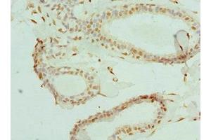 Immunohistochemistry of paraffin-embedded human breast cancer using ABIN7152086 at dilution of 1:100 (ELF1 antibody  (AA 1-210))