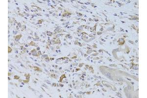 Immunohistochemistry of paraffin-embedded human breast cancer using IGF2 Antibody (ABIN6292141) at dilution of 1:100 (40x lens).