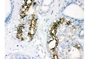 Anti-SOD2 Picoband antibody, IHC(P) IHC(P): Human Mammary Cancer Tissue (SOD2 antibody  (C-Term))