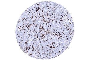 Diffuse large B cell lymphoma infiltrated by numerous CD3 positive non neoplastic lymphocytes (Recombinant CD3 antibody  (AA 20-40))