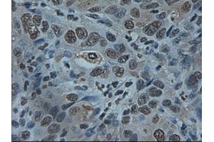 Immunohistochemical staining of paraffin-embedded Carcinoma of liver using anti-ID2 (ABIN2452680) mouse monoclonal antibody. (Id2 antibody)