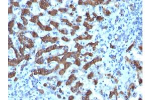 Formalin-fixed, paraffin-embedded human Hepatocellular Ca stained with CPS1 Monoclonal Antibody (CPS1/1022). (CPS1 antibody)