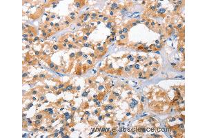 Immunohistochemistry of Human gastric cancer using BNIP3L Polyclonal Antibody at dilution of 1:40