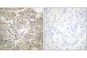 Immunohistochemistry analysis of paraffin-embedded human lung carcinoma, using Tryptophan Hydroxylase (Phospho-Ser260) Antibody. (Tryptophan Hydroxylase 1 antibody  (pSer260))