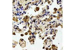 Immunohistochemical analysis of STMN1 (pS38) staining in human lung cancer formalin fixed paraffin embedded tissue section.