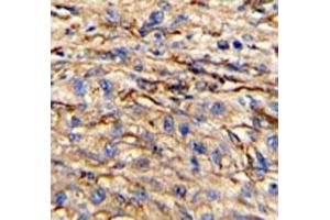IHC analysis of FFPE human hepatocarcinoma stained with Nestin antibody (Nestin antibody  (AA 1389-1416))