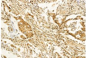 ABIN6259767 and ABIN6272861 at 1/100 staining Human pancreatic cancer by IHC-P. (ADAM12 antibody  (N-Term))