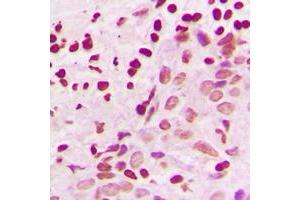 Immunohistochemical analysis of MKK3/6 staining in human breast cancer formalin fixed paraffin embedded tissue section. (MKK3/6 (Center) antibody)