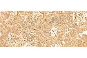 Immunohistochemistry of paraffin-embedded Human ovarian cancer tissue using ST8SIA4 Polyclonal Antibody at dilution of 1:50(x200) (ST8SIA4 antibody)