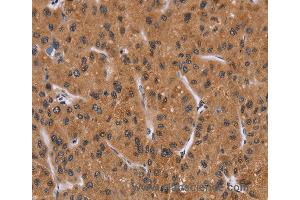 Immunohistochemistry of Human liver cancer using PPIB Polyclonal Antibody at dilution of 1:40 (PPIB antibody)