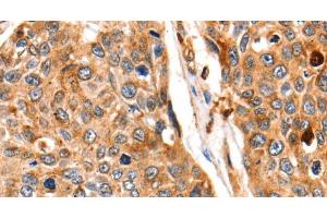 Immunohistochemistry of paraffin-embedded Human esophagus cancer tissue using Cathepsin B Polyclonal Antibody at dilution 1:140 (Cathepsin B antibody)
