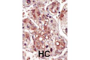 Formalin-fixed and paraffin-embedded human hepatocellular carcinoma tissue reacted with MAP2K2 polyclonal antibody  , which was peroxidase-conjugated to the secondary antibody, followed by DAB staining. (MEK2 antibody  (AA 262-292))