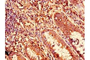 Immunohistochemistry of paraffin-embedded human colon cancer using ABIN7157408 at dilution of 1:100 (KRT81 antibody  (AA 3-505))